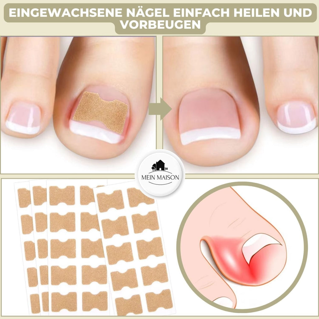 Ingrown Toenail Corrector Patches Elastic Adhesive Peel and Stick 10 Pack - Image 2
