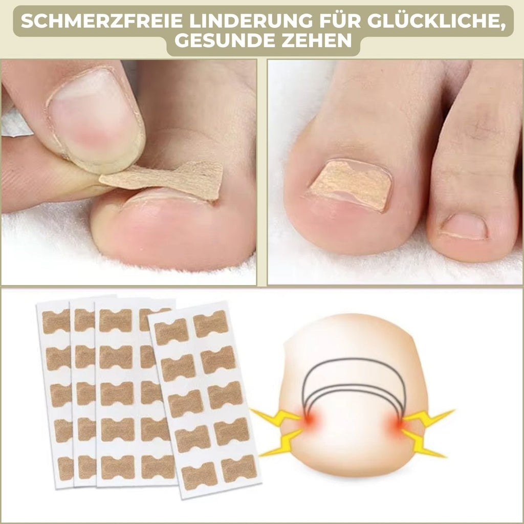 Ingrown Toenail Corrector Patches Elastic Adhesive Peel and Stick 10 Pack - Image 3