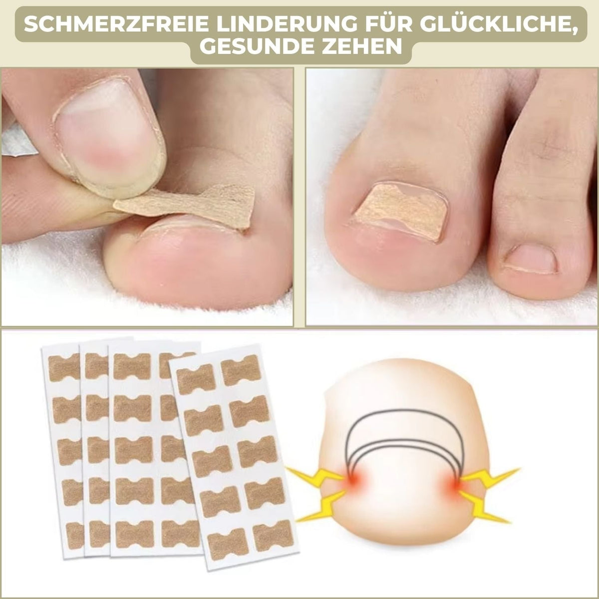 Ingrown Toenail Corrector Patches Elastic Adhesive Peel and Stick 10 Pack - Image 3