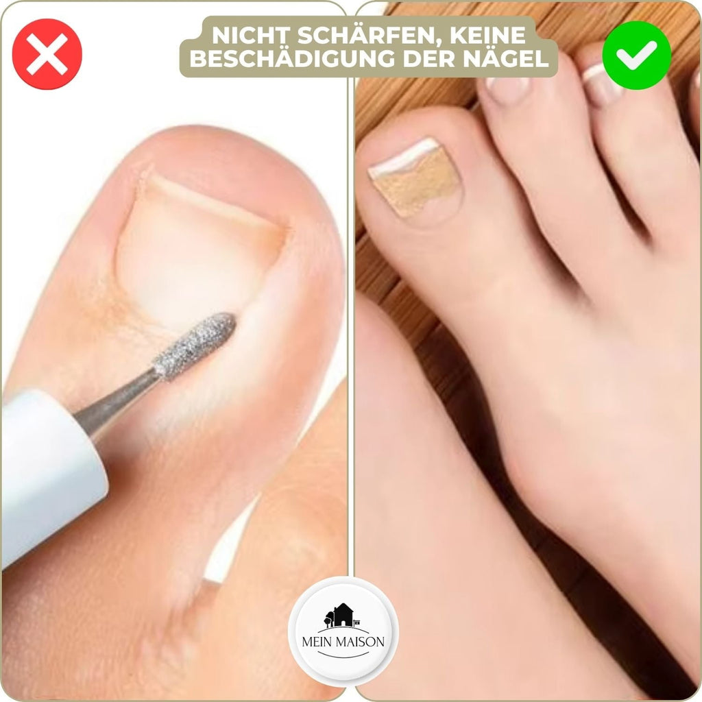 Ingrown Toenail Corrector Patches Elastic Adhesive Peel and Stick 10 Pack - Image 5