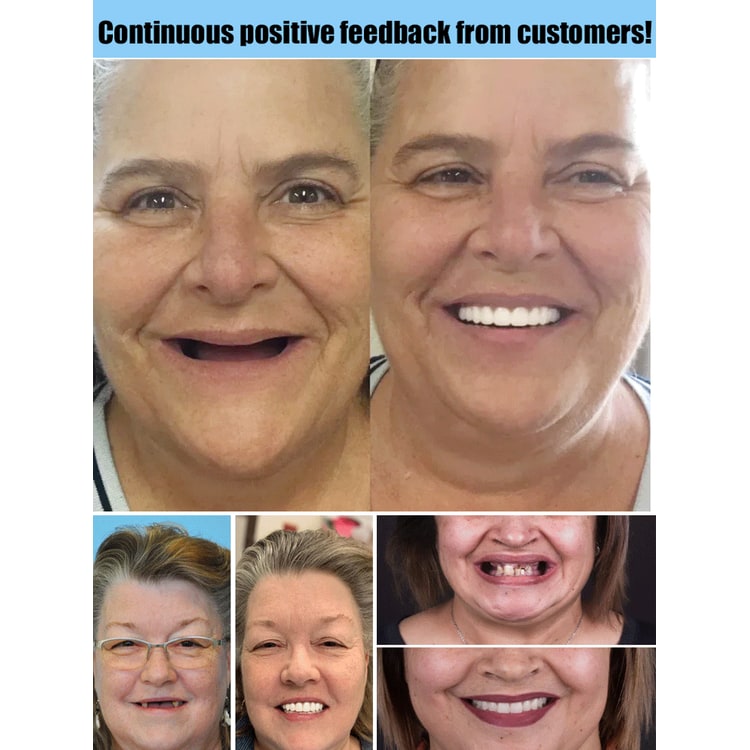 Snap on Veneers Upper and Lower Teeth with Moldable Fit and Reusable Denture Set - Image 5